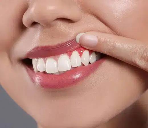 Arestin treatment Houston at Winning Smiles Dental