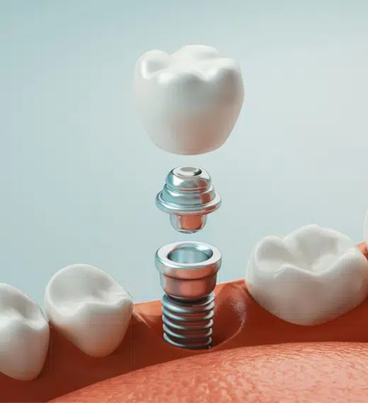 Dental Implant Restoration Houston at Cosmetic Dentist Houston at Winning Smiles Dental