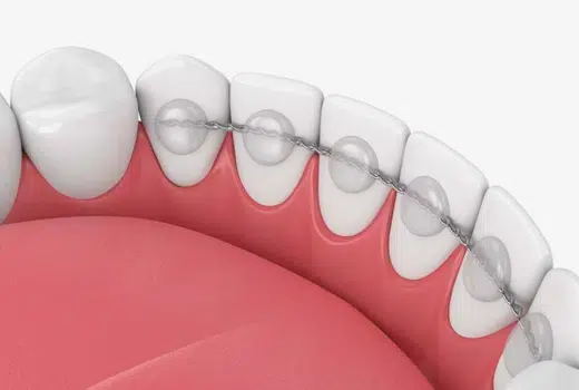 Dental Bonding Houston at Winning Smiles Dental