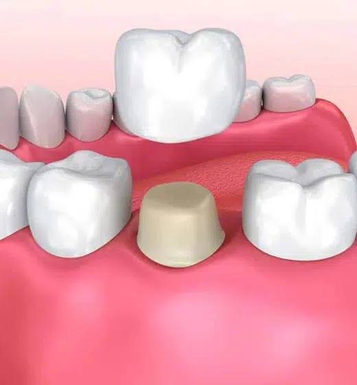 Dental Crowns Houston at Cosmetic Dentist Houston at Winning Smiles Dental