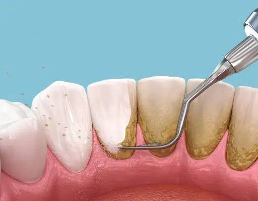 Periodontal Therapy Houston at Winning Smiles Dental
