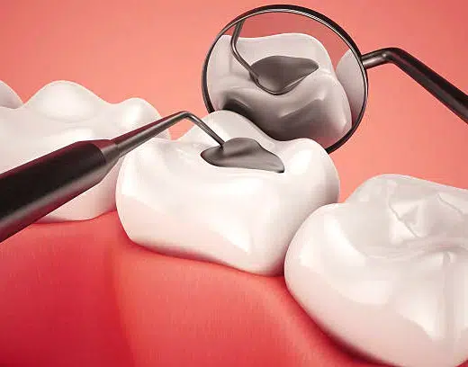 White Fillings Houston at Winning Smiles Dental