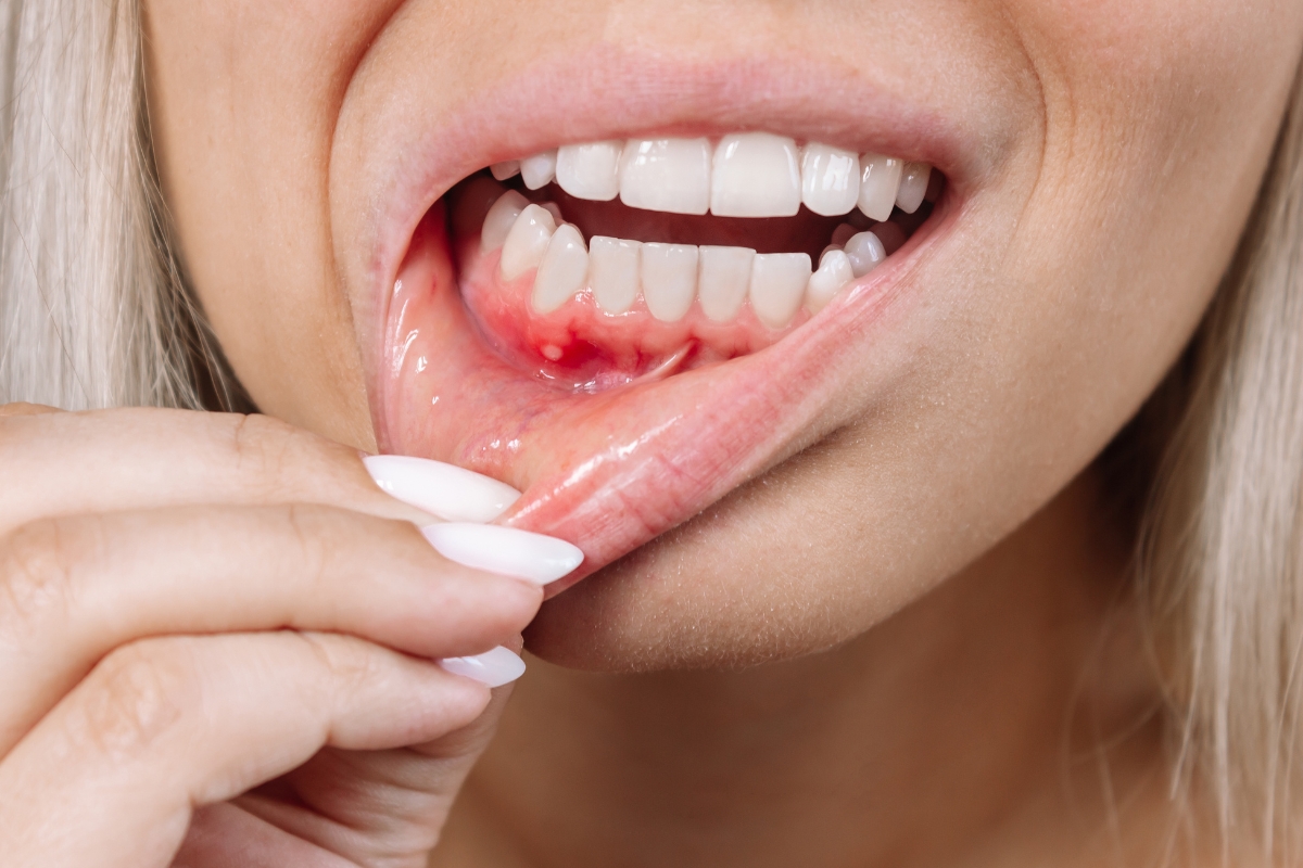 leading causes of gum disease