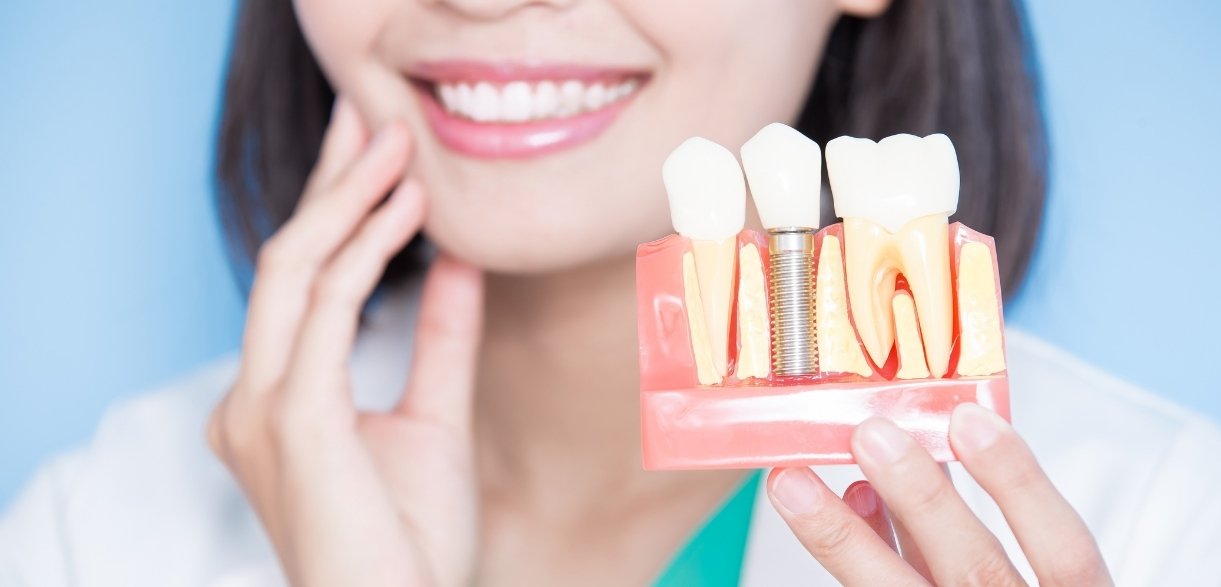 dental implants for missing teeth