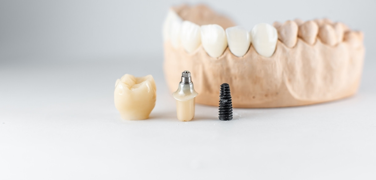 how long dental implant restorations last