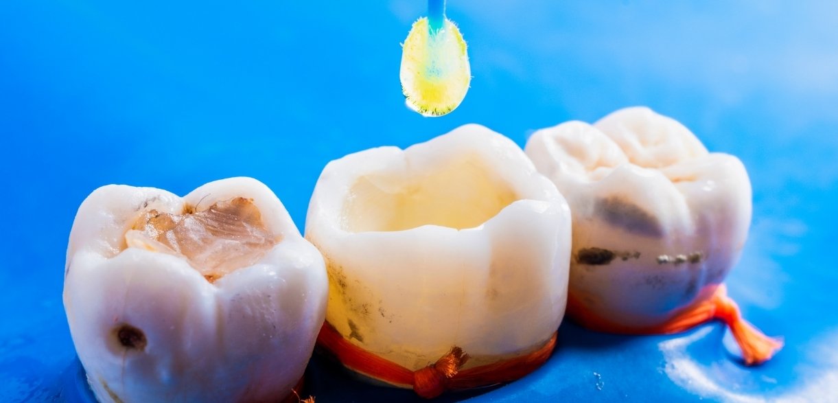 how white fillings treat front teeth cavities
