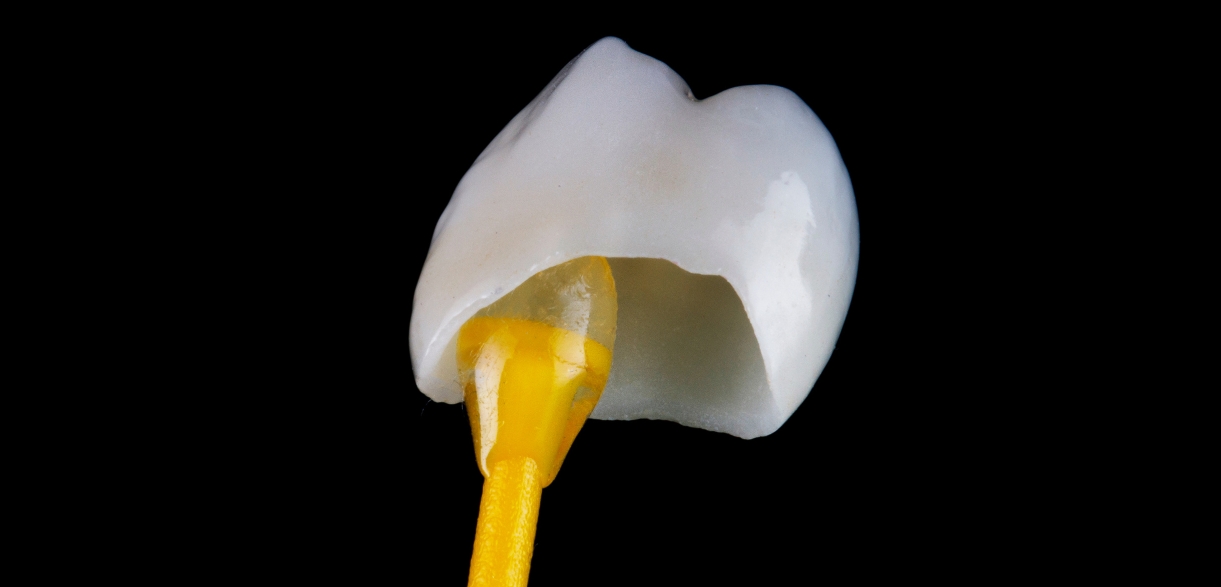 Why You Might Need A Dental Crown Removed? A Guide