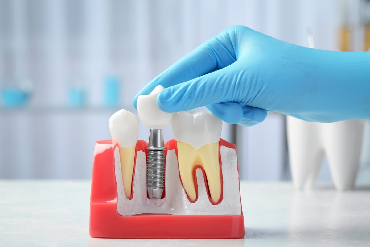 Dental Crowns in Oak Cliff Place