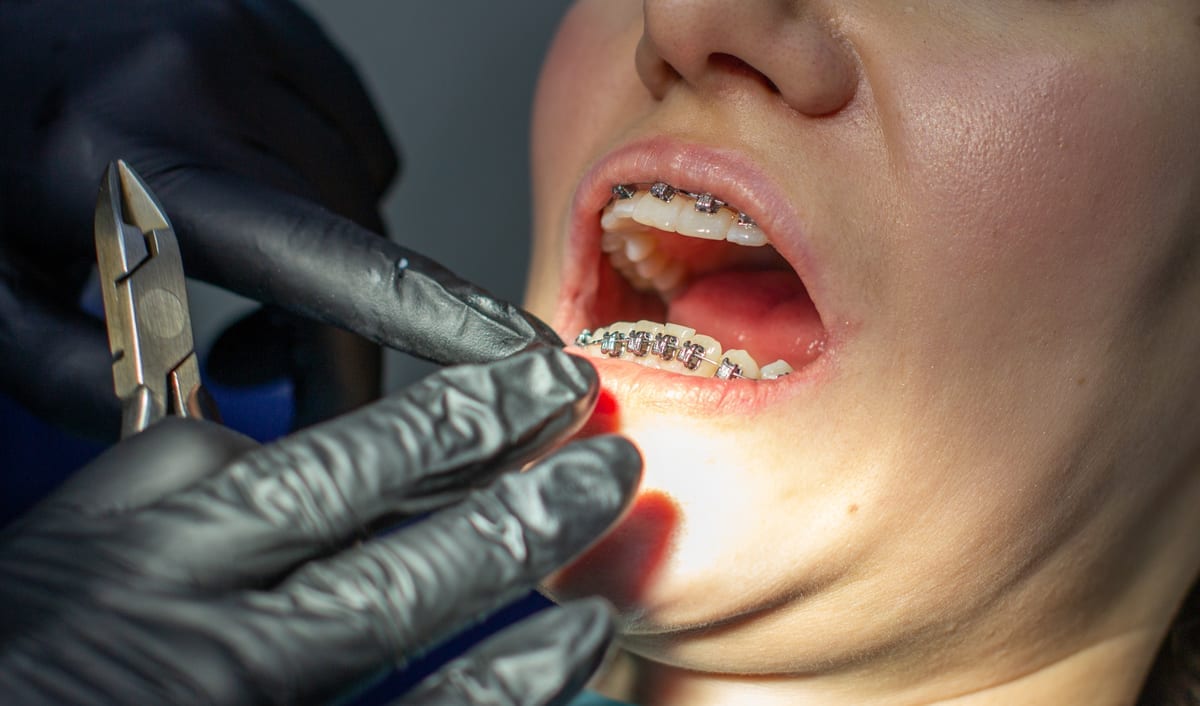 Full-Mouth Restoration in Houston